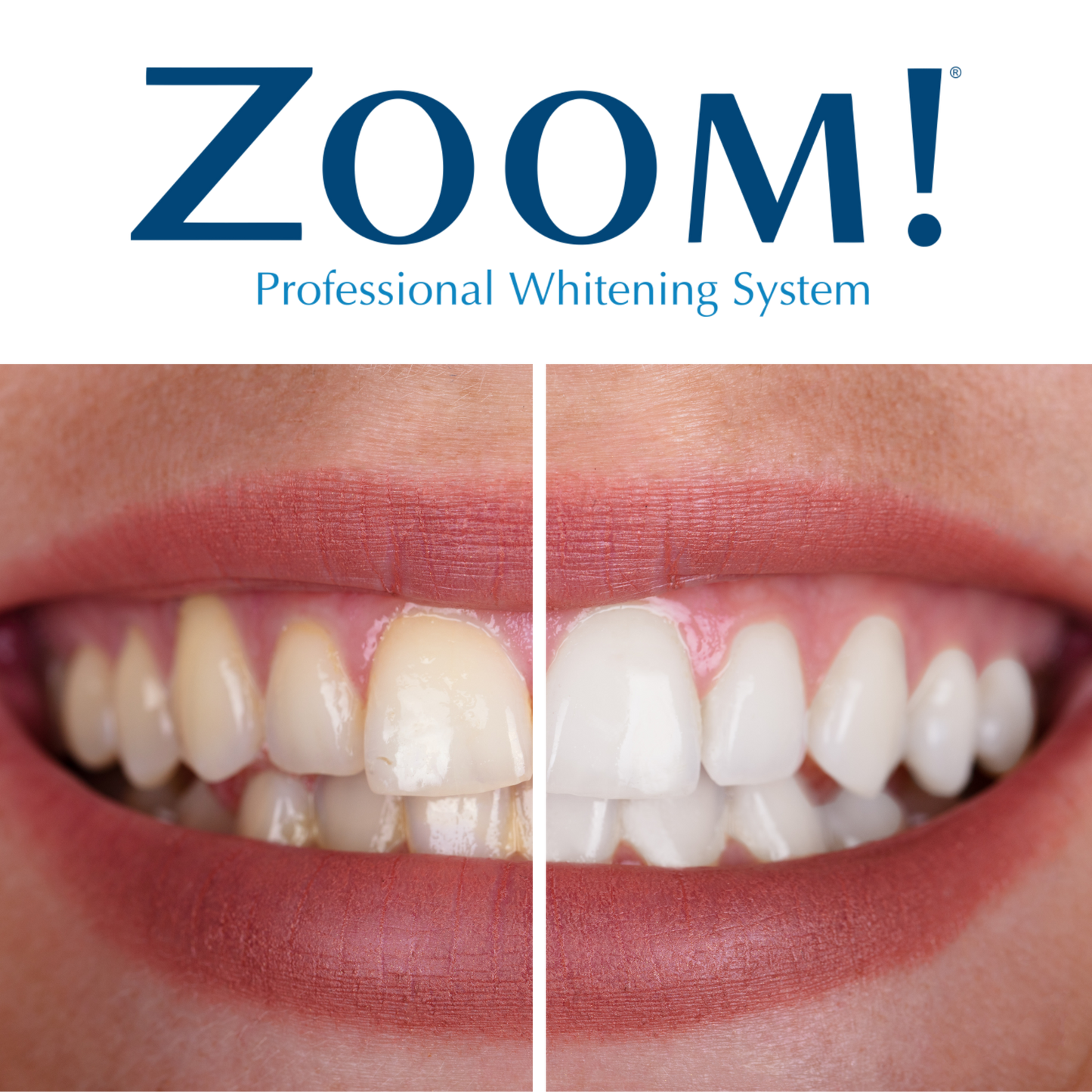 Zoom Whitening Gift Card